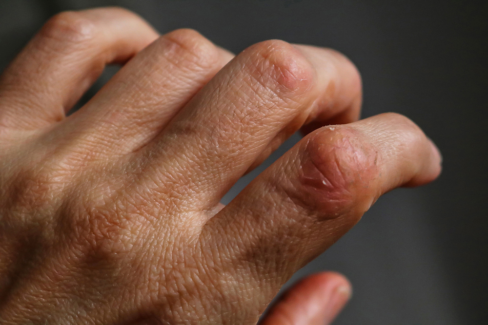 person has hand arthritis